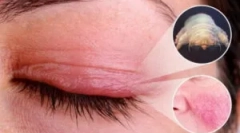 Демодекоза: причини, симптоми и лечение