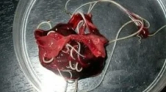 Червеи в чернодробните тъкани