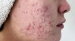 Как се предава демодикоза?