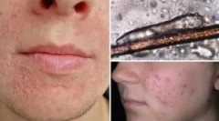 Анализ на доставката при демодекоза